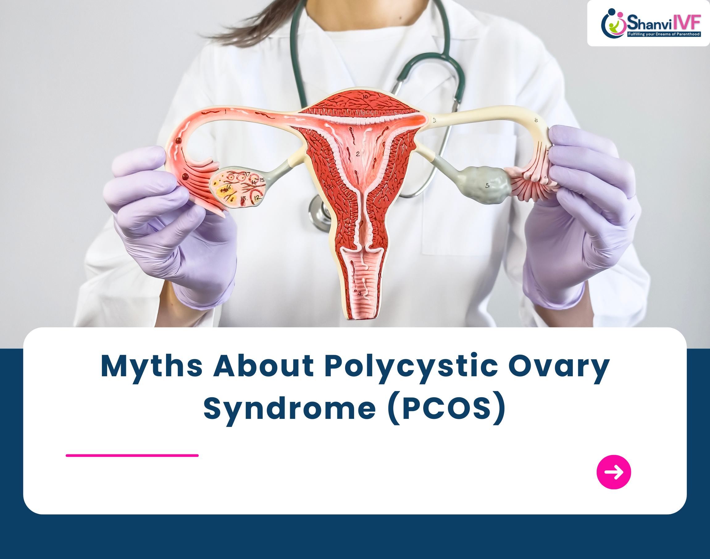 Myths About Polycystic Ovary Syndrome